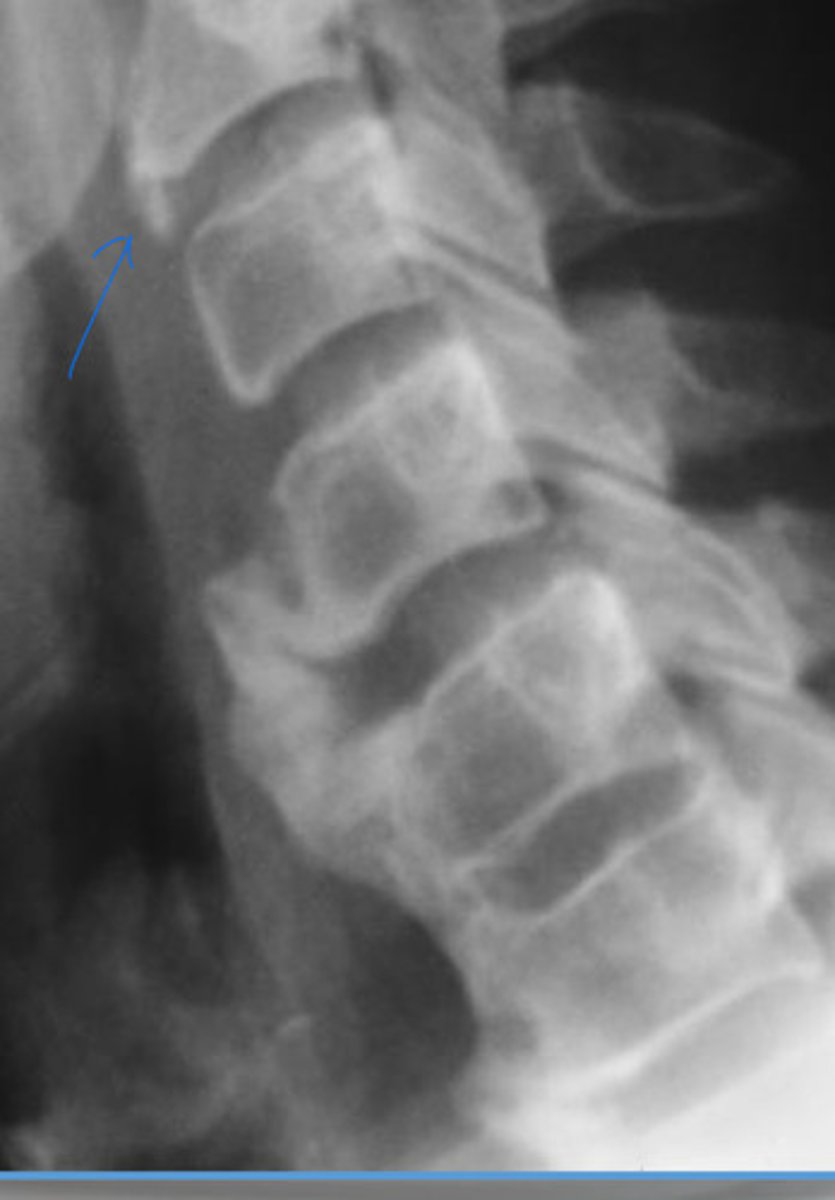 <p>What is the blue arrow pointing at?</p>