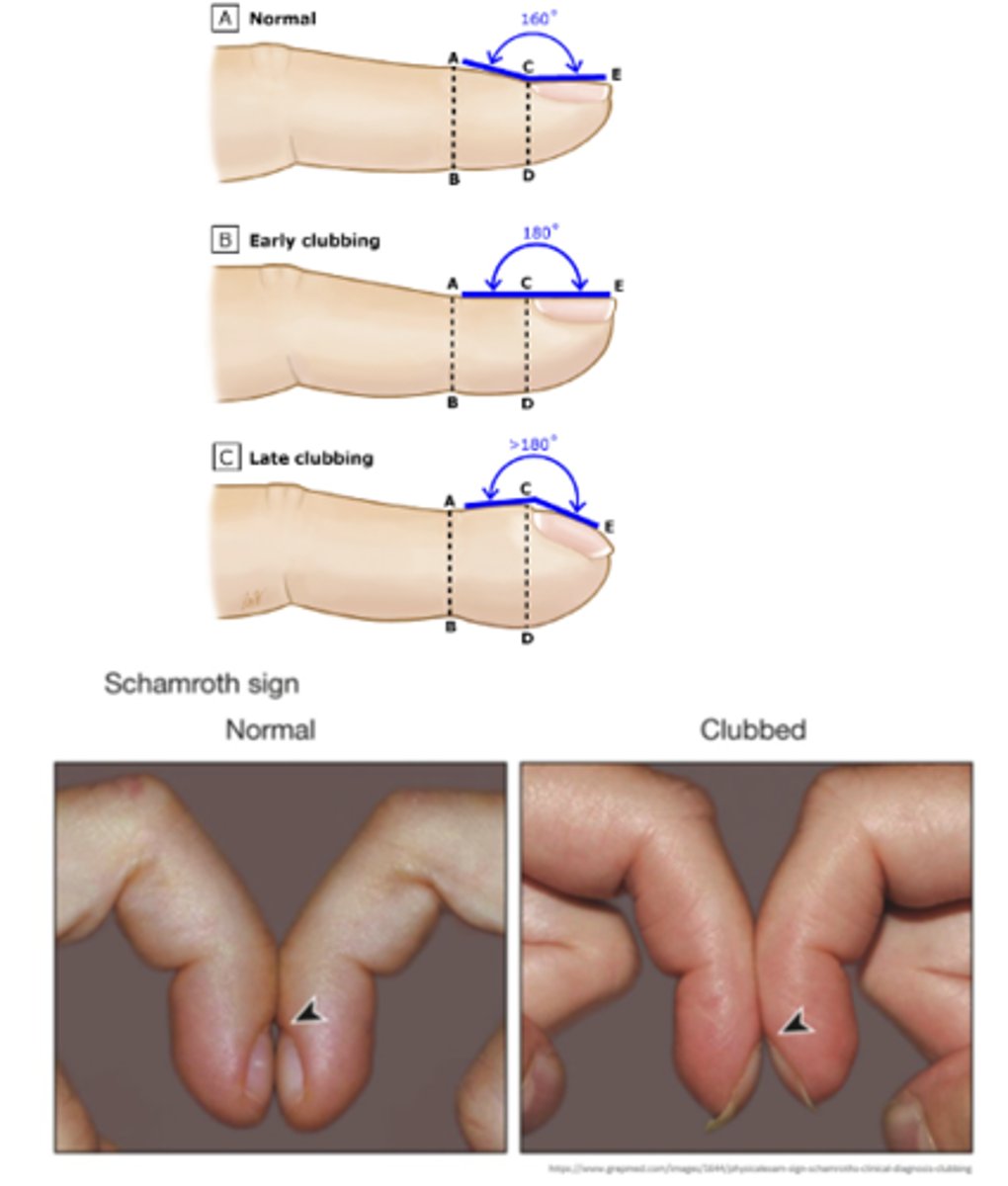 <p>-abnormal curving of the nails that is often accompanied by enlargement of the fingertips</p><p>-occurs with congenital cyanotic heart disease, lung cancer, and pulmonary diseases (abnormal finding).</p><p>angle straightens out to 180 degrees, and the nail base feels spongy to palpation (abnormal finding).</p>