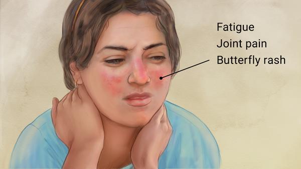 <p>Autoimmune disease affecting multiple organs.</p>