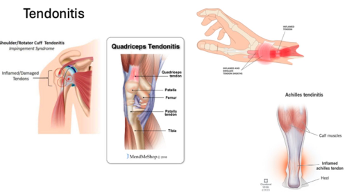 <p>- Shoulder tendonitis</p><p>- Tennis/Golfers elbow</p><p>- Achilles tendonitis</p><p>- Patella/Quad tendonitis</p><p>- Wrist tendonitis</p><p>- De Quervain's tenosynovitis</p>