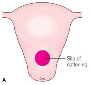 <p>soft spot anteriorly in middle of uterus near the junction of the body of the uterus and the cervix</p>