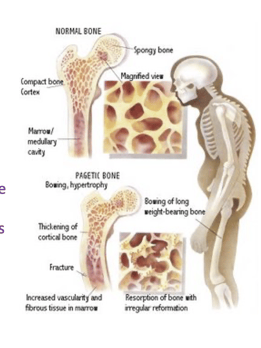 <p>Second most common metabolic bone disease after osteoporosis</p><p>- Often asymptomatic (~70%)</p><p>- ~3% of US population</p><p>- ~10% of people 80+ yrs</p><p>Characterized by</p><p>- Focal areas of excessive osteoclast-mediated bone resorption</p><p>- Disorganized osteoblast-mediated bone repair</p><p>- Disorganized, thickened, but soft bones</p><p>Genetic and environmental influences:</p><p>- Mutations in RANK pathways</p><p>- Viral origin debated</p>
