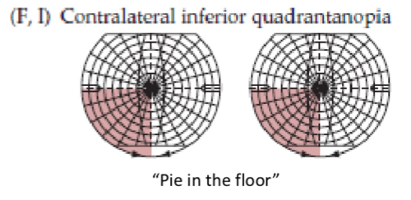 <p>Contralateral inferior quadrantanopia</p>