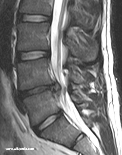 <p>What are symptoms of intervertebral disc herniation?</p>
