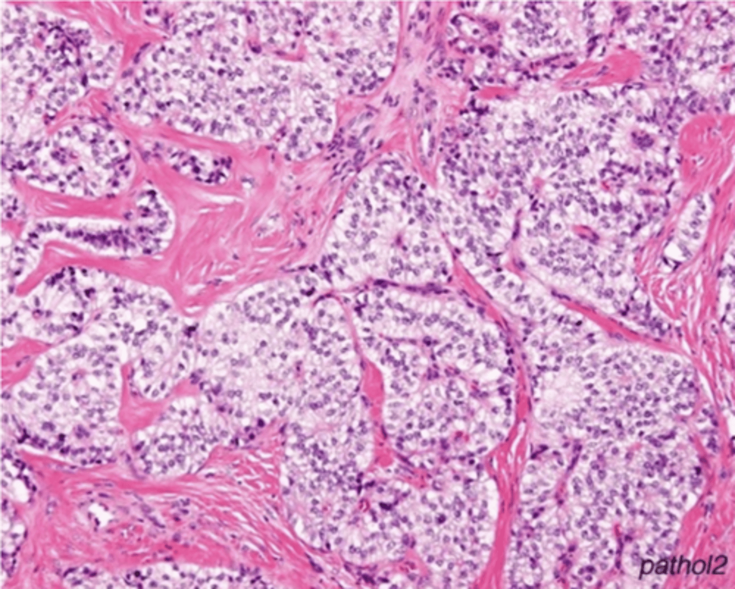 <p>Define Condition:</p><p>Type of Islet Cell Tumor/PanNET</p><p>-Hx:</p><p>&gt; Usually in ADULTS</p><p>&gt; USUALLY BENIGN</p><p>-Path: Tumor of Beta cells --&gt; overproduce insulin --&gt; Hypoglycemia</p><p>&gt; Functional Tumor</p><p>&gt; May be part of MEN1 Syndrome</p><p>-Dx:</p><p>Labs</p><p>&gt; Glucose = LOW</p><p>&gt; Insulin = HIGH</p><p>&gt; C-Peptide = HIGH</p><p>Histo = Cells arranged in NESTS (Monotonous cells demonstrating round nuclei w/ salt + pepper-like chromatin and abundant cytoplasm)</p>