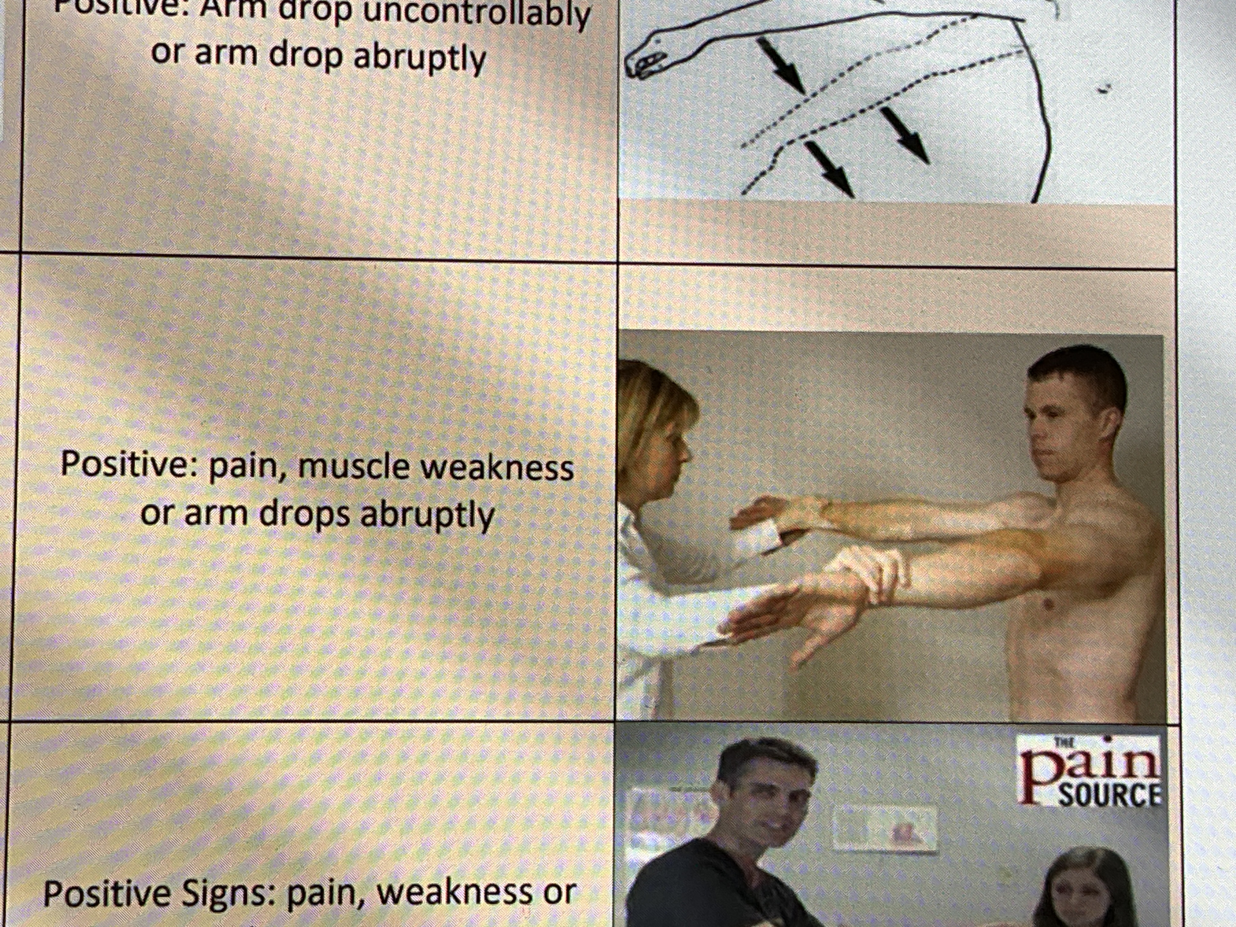 <p><strong>Indication:</strong> To assess for supraspinatus tendinitis, weakness or rotator cuff tear​</p><p><strong>Steps:</strong> ​</p><ol><li><p>The client sits with the shoulder in 90 degrees of abduction and then, adducts the&nbsp;humerus horizontally to 30 degrees(overlap in the scapular plane). ​</p></li><li><p>The client is instructed to internally rotate the humerus so that the thumb points toward the&nbsp;floor as if the client were holding a can full of liquid tand hen emptying it. ​</p></li><li><p>The therapist applies pressure to the arm in the direction of adduction while the client resists against adduction. ​</p></li></ol><p><strong>Positive</strong>: pain, muscle weakness or arm drops abruptly​</p><p></p>