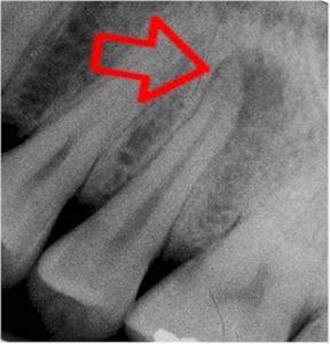 <p>- Location: Arises at the tip of the tooth's root (apex), typically due to an infection that originates within the dental pulp (inside the tooth) and spreads to the surrounding tissues.</p><p>- Cause: Often results from untreated dental decay, deep cavities, or dental trauma that allows bacteria to enter the pulp chamber, leading to pulpitis (inflammation of the pulp) and eventual infection of the periapical area.</p><p>- Symptoms: Symptoms include severe, throbbing tooth pain, swelling, and the formation of a localised pus-filled swelling (abscess) near the affected tooth. The tooth may be sensitive to touch or pressure.</p><p>- Treatment: Treatment usually involves root canal therapy or extraction to eliminate the infected pulp and drain the abscess</p>