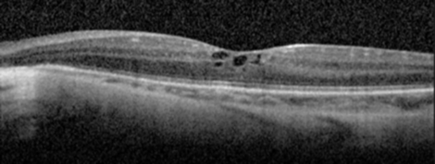 <p>dense PSC early in life (2nd decade)</p><p>CME</p>