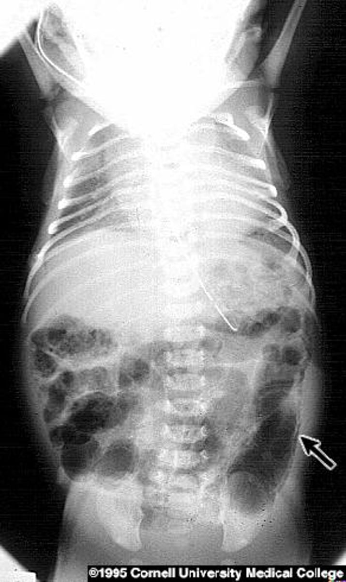 <p>A 5 day old former 33 weeker develops bloody diarrhea</p><p>- What do you see on xray?</p><p>- Treatment?</p><p>- Risk factors?</p>