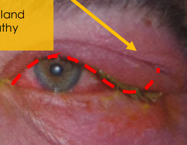 <ol><li><p>upper eyelid is swollen on one side </p></li><li><p>swollen</p></li><li><p>pufy </p></li><li><p>painful to touch</p></li><li><p>past few days </p></li><li><p>fever and flu symptoms </p></li></ol><p></p>
