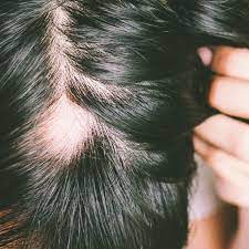 <p>sudden hair loss that starts with one or more circular bald patches that may overlap.</p>