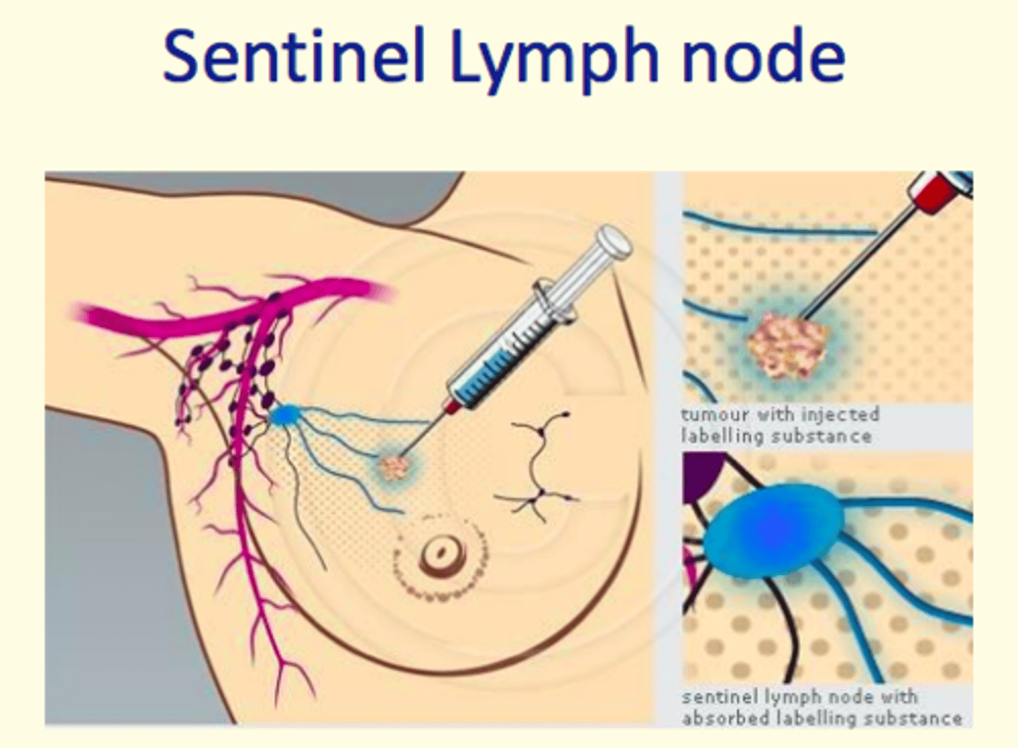 <p>Injection of blue dye and/or radioactive isotope (labelling substance) used to identify the sentinel lymph nodes (sentinel lymph node absorbs labelling substance)</p><p>This procedure helps give lymph node (N) status</p>