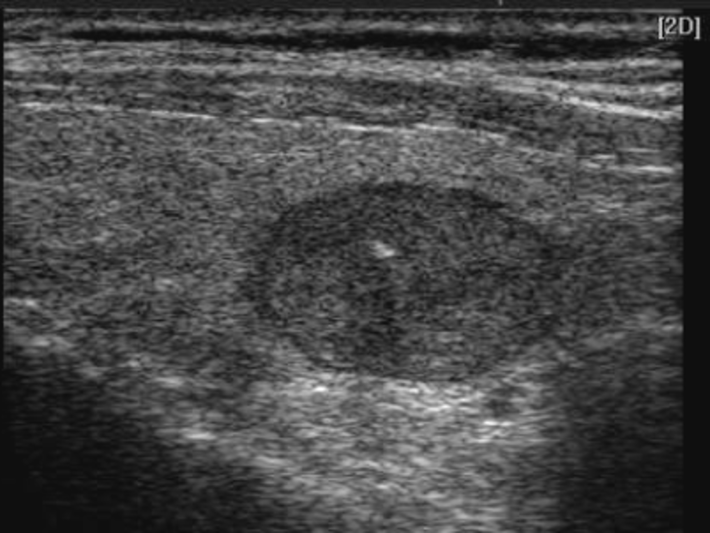 <p>Echogenic (hypoechoic, medium or hyperechoic)</p>
