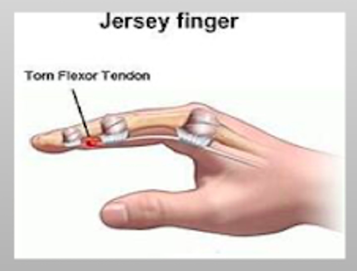 <p>avulsion of the FLEXOR tendon insertion at the DIP base</p><p>- most commonly in the ring finger</p><p>- unable to flex at the finger tip</p>