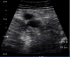 <p>What is site 5 of a DVT?</p>