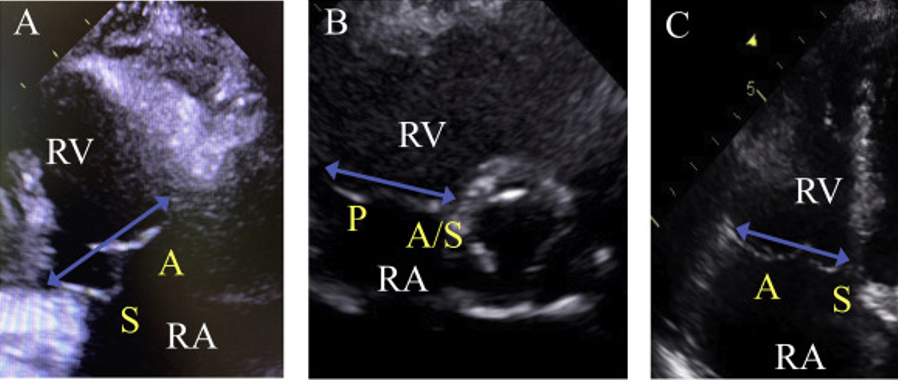 <p><span style="font-family: &quot;Calibri Light&quot;">_____________is an infrequent echocardiographic finding that is most commonly associated with mitral valve prolapse.</span></p>
