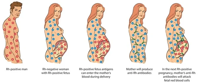 <p>In the Rh blood group, antibody formation can only occur in</p>