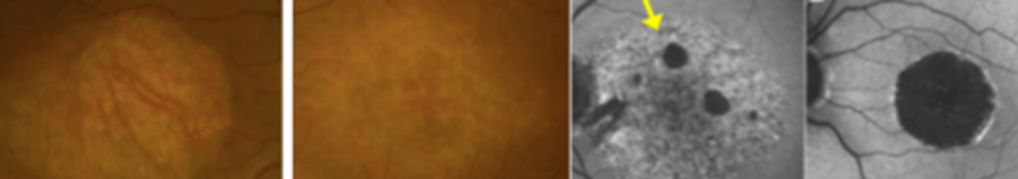 <p>an autosomal dominant condition resulting in progressive significant vision loss due to a mutation in the peripherin 2 (PRPH 2) gene. Progresses in stages, but appears extremely similar to AMD throughout making it difficult to diagnose. Presents as decreased vision and scotoma. Low vision referral and genetic testing indicated.</p>