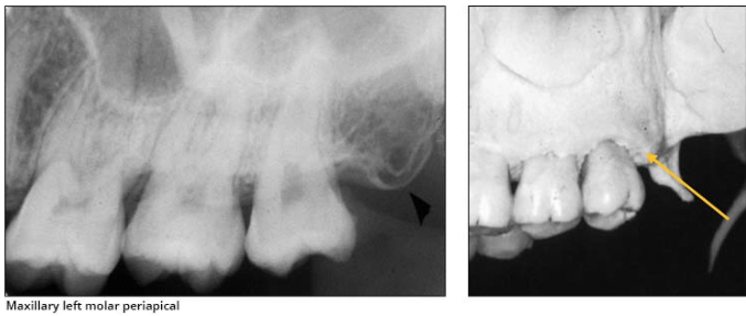 <p>Maxillary tuberosity </p><ul><li><p>rounded prominence of bone that extends posterior to the third molar region</p></li><li><p><u>Radiography:</u><strong><u> radiopaque</u></strong><u> bulge, distal to the third molar region</u></p></li></ul><p></p>
