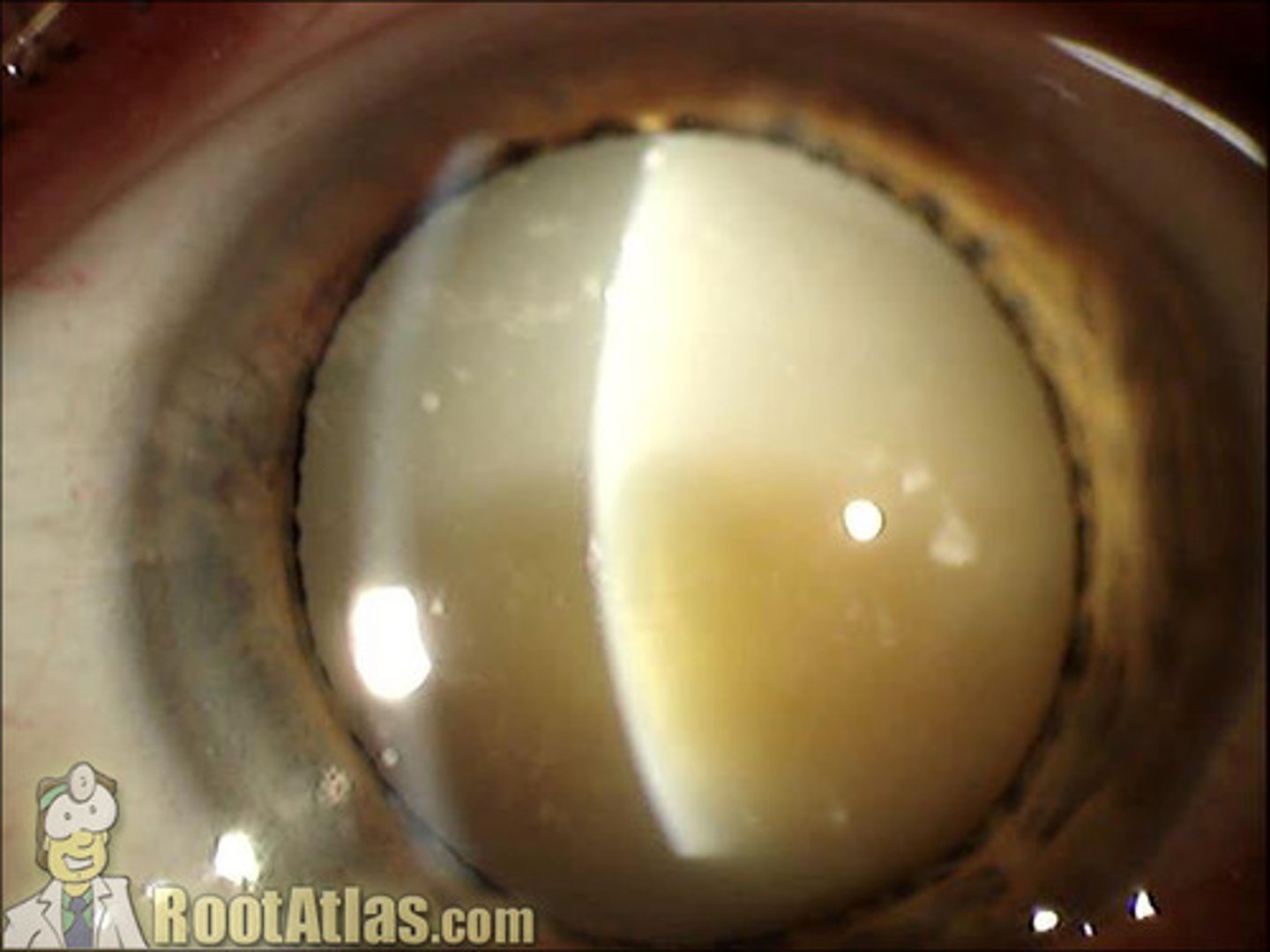 <p>mature cataract with liquefaction of the cortex and sinking of the nucleus to the bottom of the lens capsule</p>