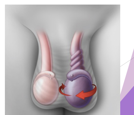 <p>Torsion of spermatic cord</p>