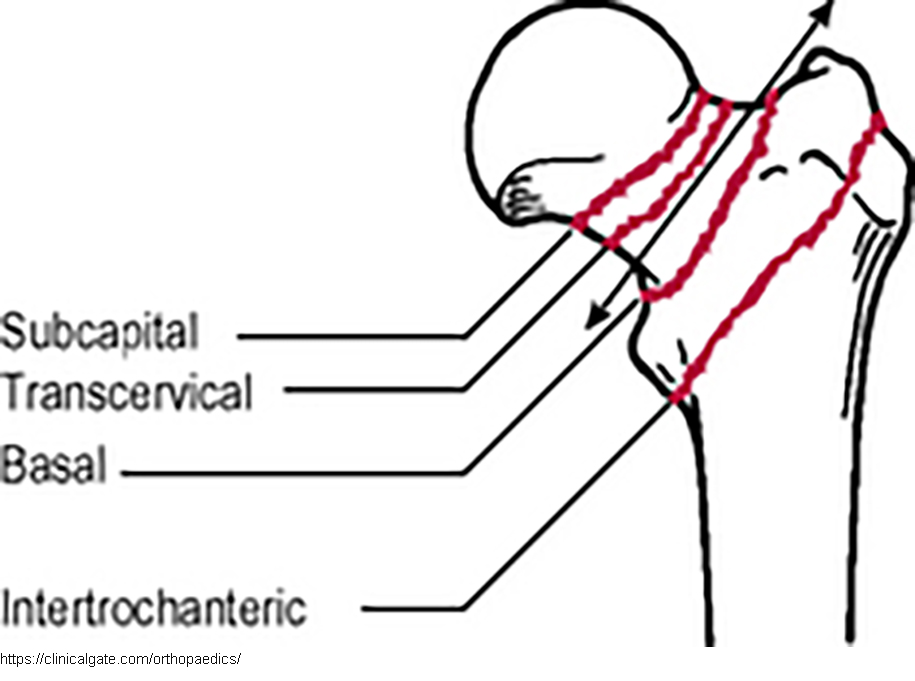 <p>What extra complication may occur with basilar fractures?</p>