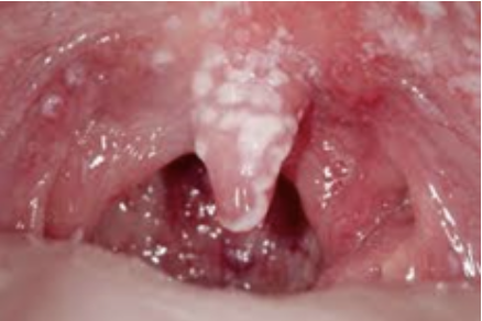 <p>How would you document the white spots found in this patient’s mouth?</p>