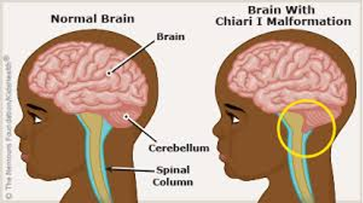 <p><span>Hydrocephalus </span><strong><span>(</span></strong><span><strong><span>Chiari Malformation)</span></strong></span></p>