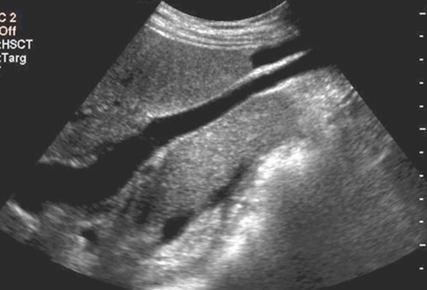 <p>Recanalized umbilical vein</p>