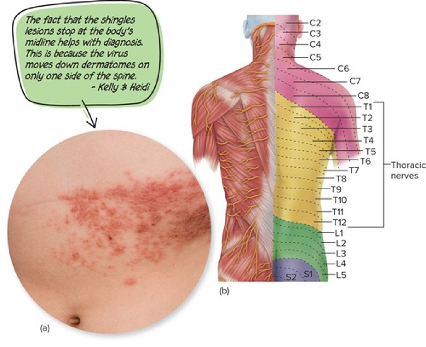 <p>Sore throat, dry cough, headache, conjunctivitis, lymphadenitis, fever, Koplik's spots, and a red maculopapular rash.</p>