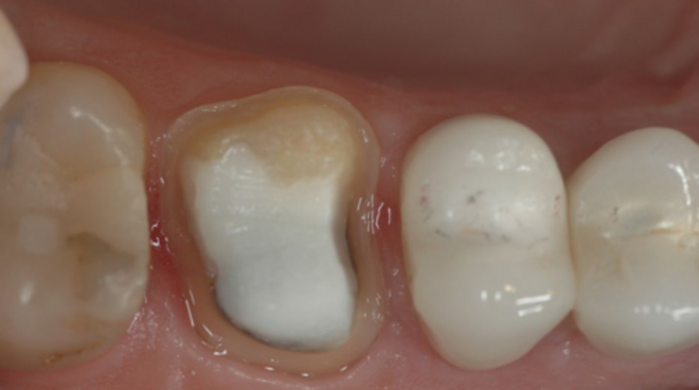 <p>How would you define the structural damage to this tooth?</p>