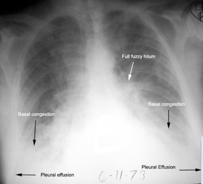 <p>What pathology is seen on this x-ray?</p>