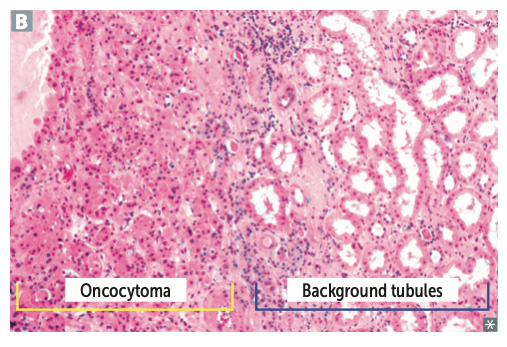 Large eosinophilic cells with abundant mitochondria without perinuclear clearing