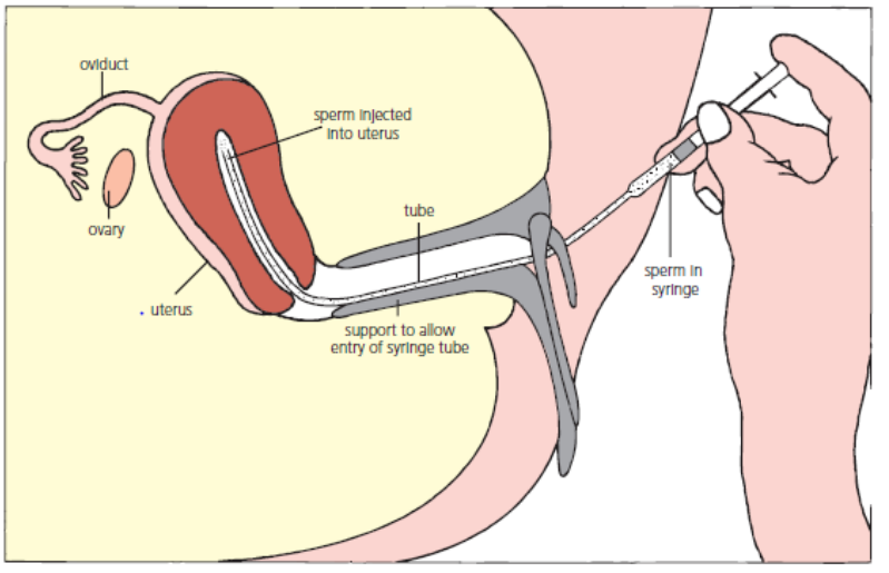 <ul><li><p>The insertion of semen into the female tract by means other than sexual intercourse.</p></li><li><p>Several samples of semen are collected over a period of time, and then released into the female at the time when she is most likely to be fertile.</p></li></ul><p></p>