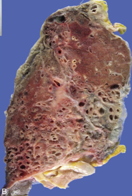 <p>¿Cómo se ve morfológicamente las bronquiectasias?</p>