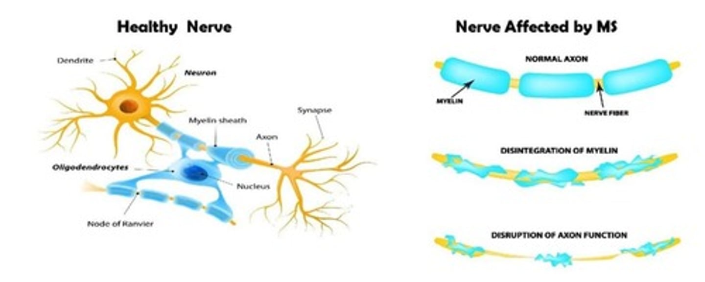 <p>Multiple Sclerosis</p>