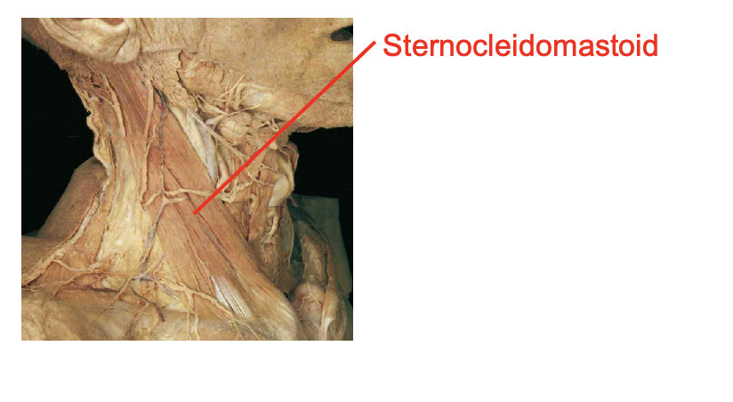 <p>Sternoceiomastoid</p><p></p><p>Origin</p><ul><li><p>Sternal head- manubrium</p></li><li><p>Clavicular head - medial clavicle</p></li></ul><p>insertion</p><ul><li><p>mastoid rocess</p></li></ul><p></p><img src="https://knowt-user-attachments.s3.amazonaws.com/e2666624-950f-4ee6-86f0-b7903133a185.png" data-width="100%" data-align="center"><p></p>
