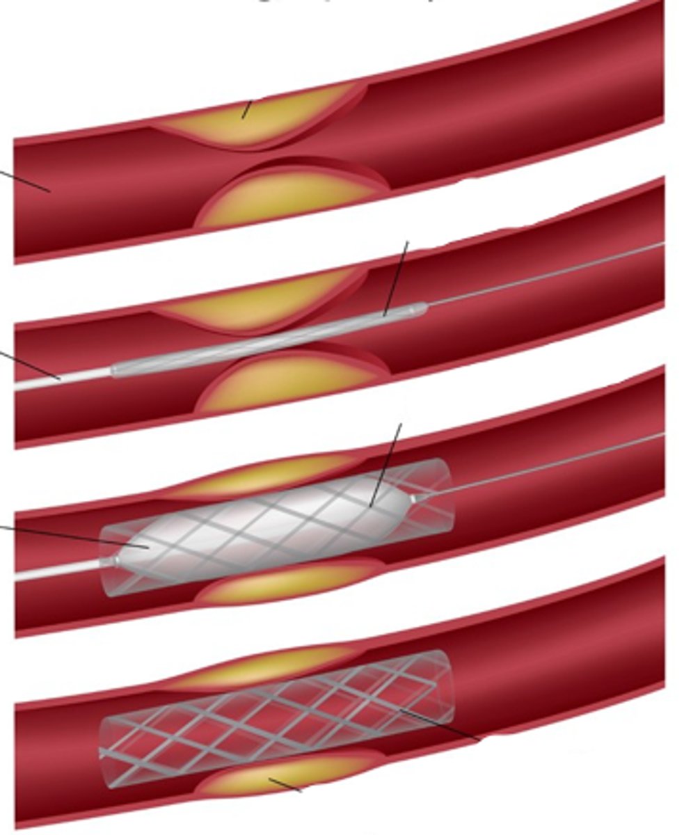 <p>what procedure is being performed in this?</p>