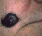 <p>COMMON DISORDERS SEEN WITH AGING</p><p>• The <span style="color: red;">most dangerous skin cancer </span></p><p>• <mark data-color="blue" style="background-color: blue; color: inherit;">Resembles a splotchy brown patch</mark> with uneven borders </p><p>• Nodular _____ appears as a brown or red raised spot </p>