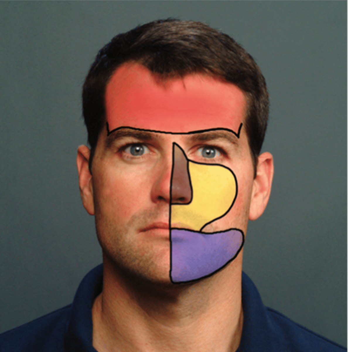 <p>- Supraorbital block: superior to eyebrow/ inline with pupil</p><p>- Infraorbital block: below eye/ maxillary canine or 2nd bicuspid teeth</p><p>- Mental block: lower lip adjacent to incisors and canines</p>