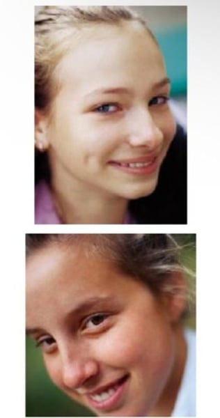 <p><strong>Dimples</strong></p><p>- <span class="bgP">dominant</span></p><p></p><p><strong>No dimples</strong></p><p>- <span class="bgP">recessive</span></p>