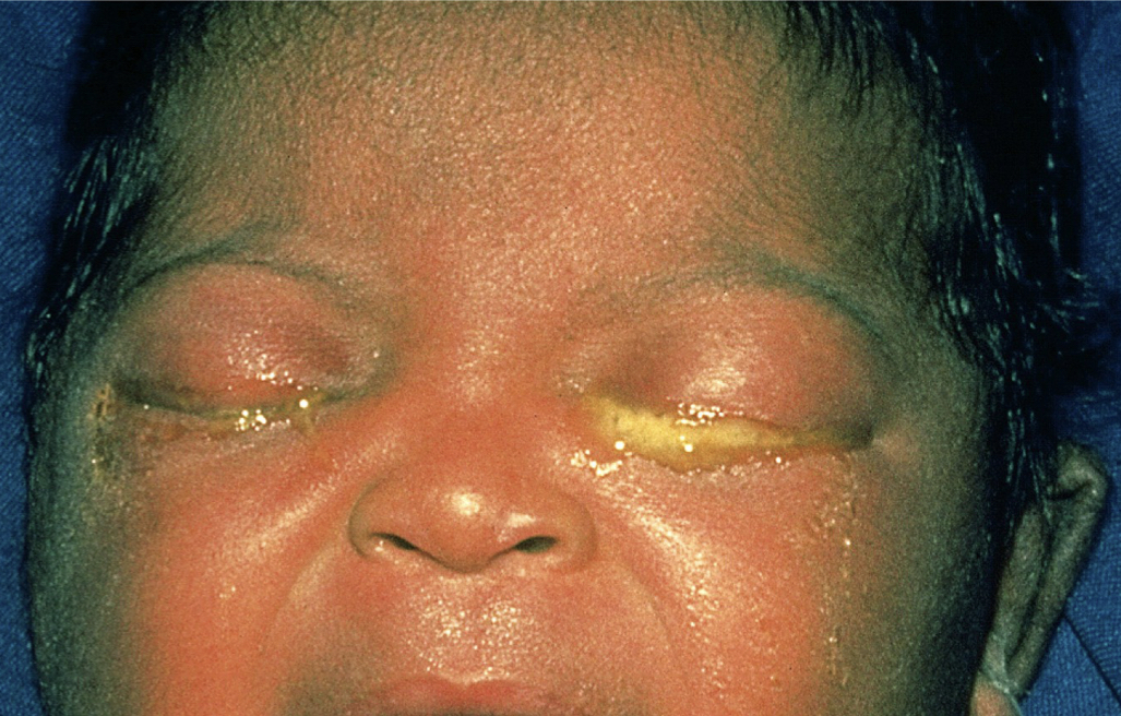 Ophthalmia neonatorum: (Bacterial diseases of the eye)