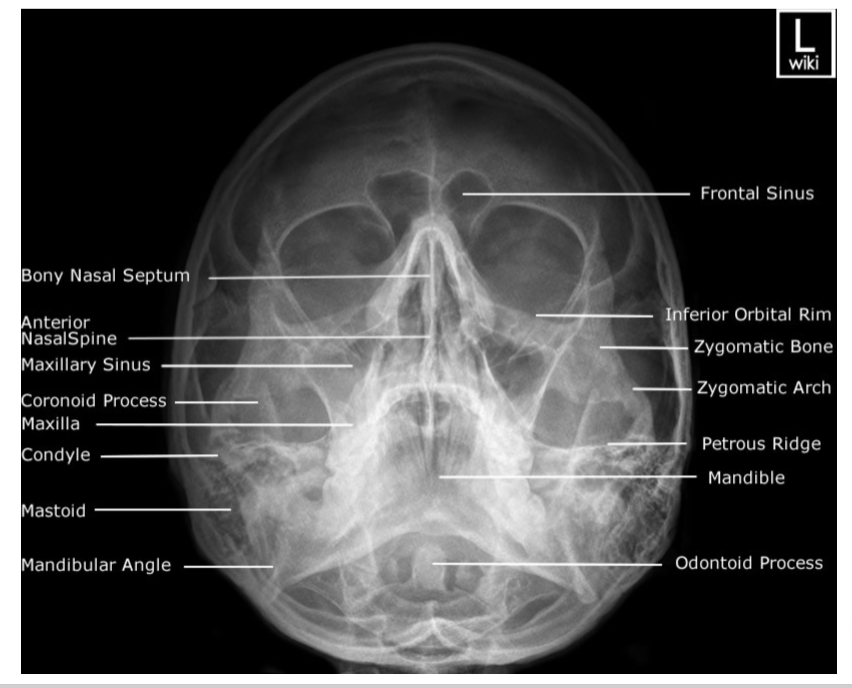 <p>Sensor is placed vertically. Patient’s face is facing the sensor. Chin is raised until the mento-mandibular line is perpendicular to the sensor. Canthomeatal line is 37-40º from receptor.</p>