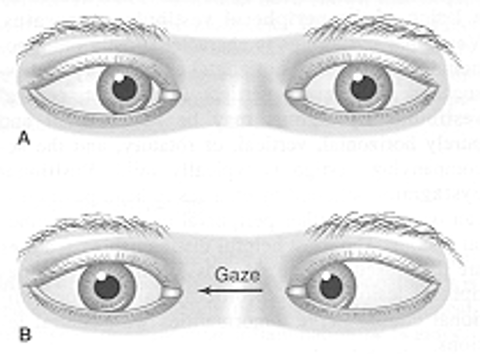 <p>What condition?</p><ul><li><p>affected eye adducted at rest & cannot abduct </p></li><li><p>MCCs: basal intracranial neoplasms, trauma, microvascular dz</p></li></ul><p></p>