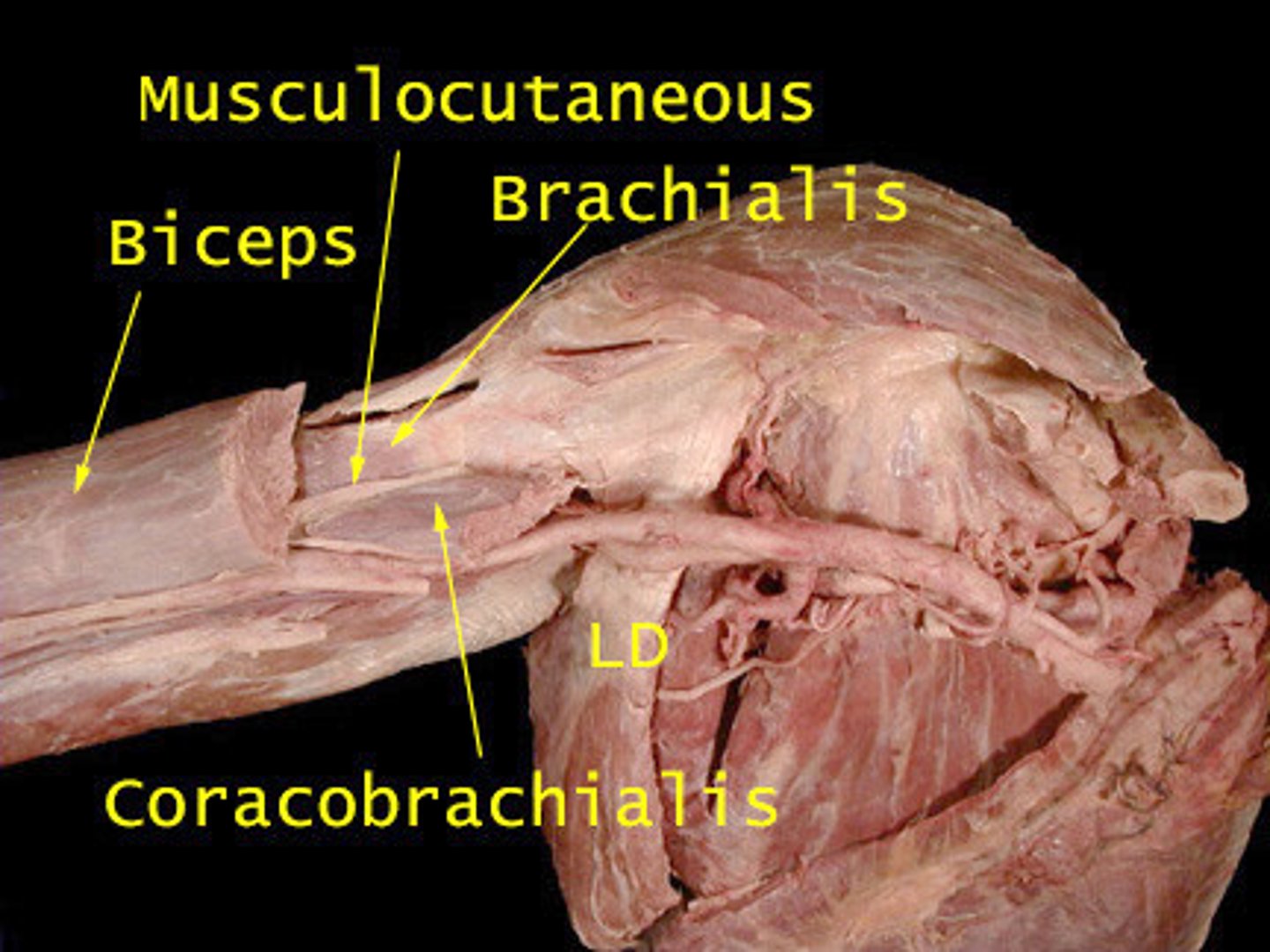 <p>musculocutaneous nerve</p>