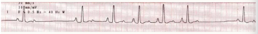 <ol><li><p>SAN = sinus</p></li><li><p>P wave, QRS complex, T wave = normal sinus rhythm</p></li><li><p><strong>slow but regular rhythm</strong></p></li><li><p>medications, electrolyte disturbances, vagal stimulation, hypothermia, hypoadrenocorticism, hypothyroidism, raised ICP</p></li></ol><p></p>