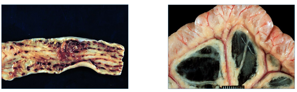 <ul><li><p>traps blood in ridges</p></li><li><p>mimics intussusception</p></li></ul><p></p>