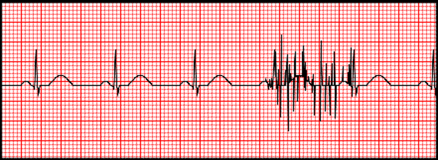 <p>uneven spikes on EKG tracing caused by muscle movement</p>