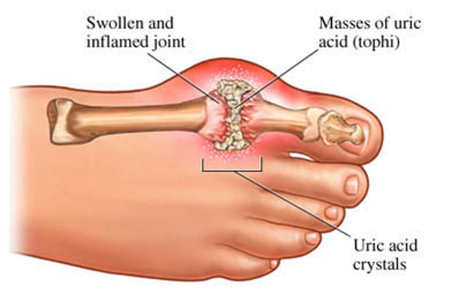 <p>Description: Deposition of uric acid crystals in joints and soft tissues, followed by an inflammatory response.</p><p>Affected joint: Base of great toes</p><p>Result: the bone ends fuse and immobilize the joint.</p><p>Treatment: colchicine, nonsteroidal anti-inflammatory drugs, and glucocorticoids</p>