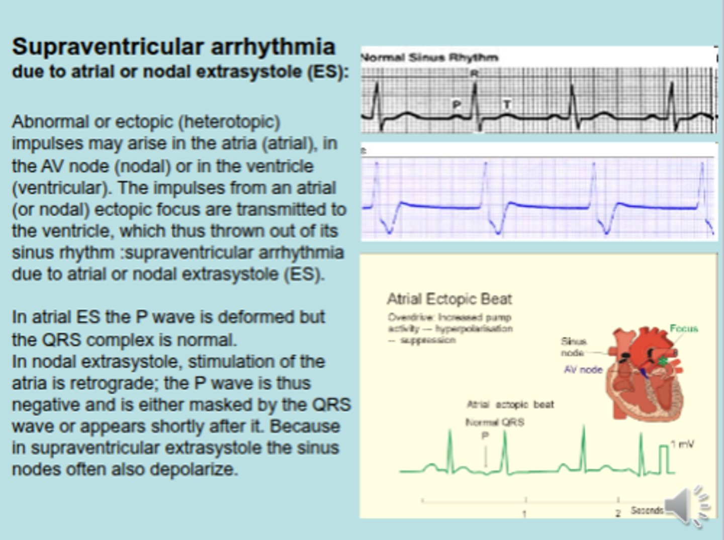 <p>abnormal contraction of the atrium shows negative P wave, atrium receives abnormal signal from ventricle. That is why it is called atrial ectopic beat</p>